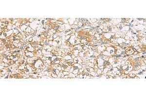 Immunohistochemistry of paraffin-embedded Human liver cancer tissue using TLE6 Polyclonal Antibody at dilution of 1:75(x200)