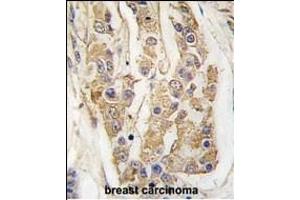 Formalin-fixed and paraffin-embedded human breast carcinoma tissue reacted with COT Antibody (C-term) (ABIN392472 and ABIN2842056) , which was peroxidase-conjugated to the secondary antibody, followed by DAB staining. (MAP3K8 抗体  (C-Term))