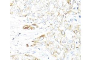 Immunohistochemistry of paraffin-embedded Human liver cancer using HSD17B10 Polyclonal Antibody at dilution of 1:100 (40x lens). (HSD17B10 抗体)