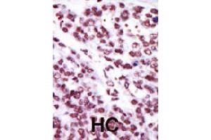 Formalin-fixed and paraffin-embedded human hepatocellular carcinoma tissue reacted with PRKCE polyclonal antibody  , which was peroxidase-conjugated to the secondary antibody, followed by AEC staining . (PKC epsilon 抗体  (AA 213-243))