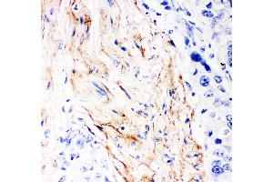 Anti- Decorin Picoband antibody, IHC(P) IHC(P): Human Mammary Cancer Tissue (Decorin 抗体  (AA 31-359))