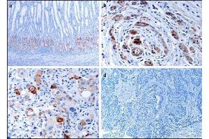 Immunohistochemical analysis of EphB1 in gastric cancer tissues. (EPH Receptor B1 抗体  (C-Term))