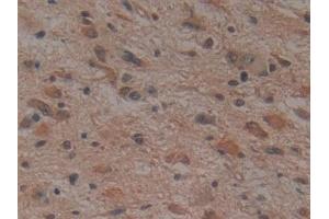 Detection of NOG in Human Glioma Tissue using Monoclonal Antibody to Noggin (NOG) (NOG 抗体  (AA 28-232))