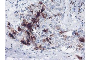 Immunohistochemical staining of paraffin-embedded Adenocarcinoma of Human breast tissue using anti-SERPINB2 mouse monoclonal antibody. (SERPINB2 抗体)