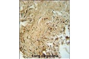 PK14 Antibody (/) f immunohistochemistry analysis in forlin fixed and paraffin embedded hun lung carcino followed by peroxidase conjugation of the secondary antibody and DAB staining. (MAPK14 抗体  (AA 158-192))