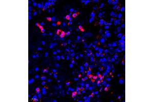 Immunofluorescence of paraffin embedded human lung cancer using UBE3A (ABIN7076105) at dilution of 1:650 (400x lens) (ube3a 抗体)