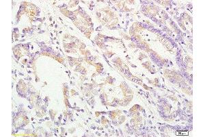 Formalin-fixed and paraffin embedded human gastric carcinoma labeled with Rabbit Anti ApoA4 Polyclonal Antibody, Unconjugated  at 1:200 followed by conjugation to the secondary antibody and DAB staining (APOA4 抗体  (AA 21-120))