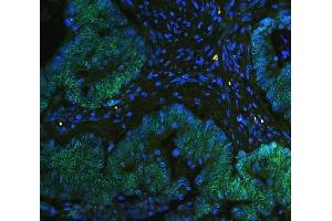 IF analysis of TPR using anti-TPR antibody (ABIN5693275) TPR was detected in paraffin-embedded section of human intestinal cancer tissues. (TPR 抗体)