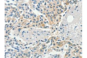 The image on the left is immunohistochemistry of paraffin-embedded Human breast cancer tissue using ABIN7190467(DGKB Antibody) at dilution 1/60, on the right is treated with synthetic peptide. (DGKB 抗体)