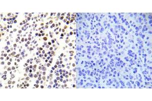 Immunohistochemical analysis of paraffin-embedded human malignant lymphoma tissue using Histone H3. (Histone H3.1 抗体  (pSer28))