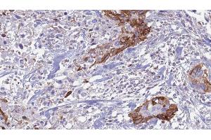 ABIN6266643 at 1/100 staining Human urothelial cancer tissue by IHC-P. (TGFA 抗体)