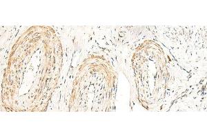 Immunohistochemistry of paraffin-embedded Human cervical cancer tissue using GPR160 Polyclonal Antibody at dilution of 1:35(x200) (GPR160 抗体)