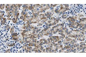 ABIN6275017 at 1/100 staining Human liver cancer tissue by IHC-P. (Claudin 6 抗体  (Internal Region))