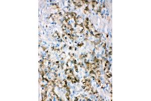 Anti-ALDH3A1 antibody, IHC(P) IHC(P): Human Gastric Cancer Tissue (ALDH3A1 抗体  (C-Term))
