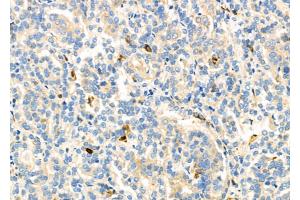 ABIN6262689 and ABIN6277155 at 1/100 staining Human kidney cancer by IHC-P.