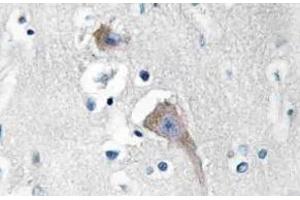 Immunohistochemistry (IHC) analyzes of CaMKIIalpha/delta antibody in paraffin-embedded human breast carcinoma tissue. (CAMK2A 抗体)