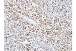 IHC-P Image Immunohistochemical analysis of paraffin-embedded human glioma, using HSP70 1B, antibody at 1:100 dilution. (HSPA1B 抗体  (Center))