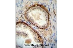 NUDT8 antibody (N-term) (ABIN654517 and ABIN2844241) immunohistochemistry analysis in formalin fixed and paraffin embedded human prostate carcinoma followed by peroxidase conjugation of the secondary antibody and DAB staining. (NUDT8 抗体  (N-Term))