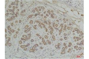 Immunohistochemistry (IHC) analysis of paraffin-embedded Human Breast Carcinoma using EphA1 Rabbit Polyclonal Antibody diluted at 1:200. (EPHA1 抗体)