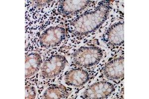 Immunohistochemical analysis of Collagen 17 alpha 1 staining in human colon cancer formalin fixed paraffin embedded tissue section. (COL17A1 抗体)