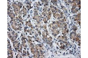 Immunohistochemical staining of paraffin-embedded Carcinoma of liver tissue using anti-LIPG mouse monoclonal antibody. (LIPG 抗体)