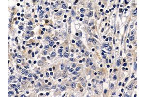 ABIN6258579 and ABIN6274824 at 1/100 staining human gastric cancer by IHC-P.