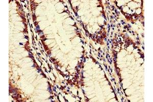 Immunohistochemistry of paraffin-embedded human colon cancer using ABIN7162603 at dilution of 1:100 (PANK2 抗体  (AA 437-490))