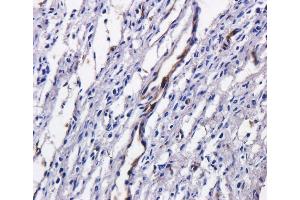 Immunohistochemical staining of human ovarian cancer using anti-TAG72 antibody  Formalin fixed human ovarian cancer slices were were stained with  at 5 µg/ml. (Recombinant TAG-72 (Satumomab Biosimilar) 抗体)