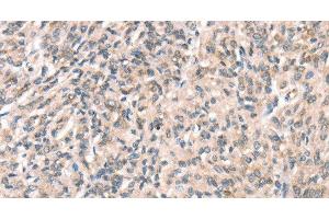 Immunohistochemistry of paraffin-embedded Human prostate cancer using DECR1 Polyclonal Antibody at dilution of 1:50 (DECR1 抗体)