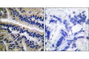 Immunohistochemistry analysis of paraffin-embedded human lung carcinoma tissue, using Caspase 9 (Cleaved-Asp353) Antibody. (Caspase 9 抗体  (Cleaved-Asp353))