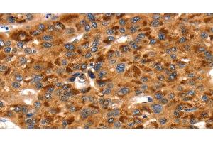 Immunohistochemistry of paraffin-embedded Human liver cancer using TLN1 Polyclonal Antibody at dilution of 1:35 (TLN1 抗体)