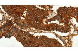 Immunohistochemistry of paraffin-embedded Human colon cancer tissue using CEACAM21 Polyclonal Antibody at dilution 1:60 (CEACAM21 抗体)