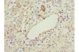 Immunohistochemistry of paraffin-embedded human liver cancer using ABIN7167073 at dilution of 1:100 (HBXIP 抗体  (AA 1-91))