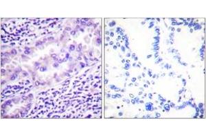 Immunohistochemistry analysis of paraffin-embedded human lung carcinoma, using PP2A-alpha (Phospho-Tyr307) Antibody. (PPP2CA 抗体  (pTyr307))