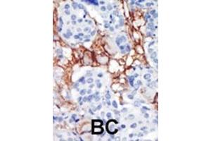Formalin-fixed and paraffin-embedded human cancer tissue reacted with the primary antibody, which was peroxidase-conjugated to the secondary antibody, followed by AEC staining. (PIP4K2B 抗体  (C-Term))