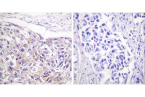 Immunohistochemistry analysis of paraffin-embedded human breast carcinoma tissue using p90 RSK (Phospho-Thr573) antibody. (RPS6KA3 抗体  (pThr573))