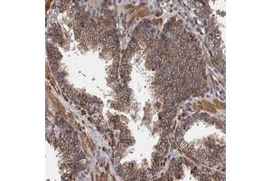 Immunohistochemical staining of human prostate with KIAA1609 polyclonal antibody  shows moderate cytoplasmic positivity in glandular cells at 1:500-1:1000 dilution.