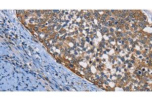 Immunohistochemistry of paraffin-embedded Human cervical cancer using PGK1 Polyclonal Antibody at dilution of 1:50 (PGK1 抗体)