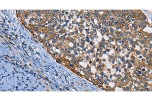 Immunohistochemistry of paraffin-embedded Human cervical cancer using PGK1 Polyclonal Antibody at dilution of 1:50 (PGK1 抗体)