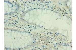 Immunohistochemistry of paraffin-embedded human colon cancer using ABIN7156908 at dilution of 1:100 (FIL1d 抗体  (AA 1-155))