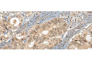 Immunohistochemistry of paraffin-embedded Human colorectal cancer tissue using CC2D1A Polyclonal Antibody at dilution of 1:35(x200) (CC2D1A 抗体)