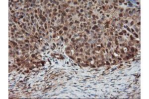 Immunohistochemical staining of paraffin-embedded Adenocarcinoma of Human ovary tissue using anti-PSMA4 mouse monoclonal antibody. (PSMA4 抗体)
