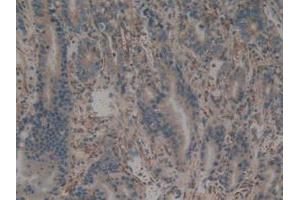 IHC-P analysis of Human Stomach Cancer Tissue, with DAB staining. (CALU 抗体  (AA 20-315))
