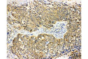 Anti-Haptoglobin antibody, IHC(P) IHC(P): Human Lung Cancer Tissue (Haptoglobin 抗体  (Middle Region))