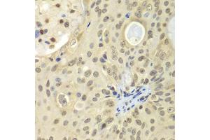 Immunohistochemistry of paraffin-embedded human oophoroma using ULK4 antibody (ABIN5975557) at dilution of 1/100 (40x lens). (ULK4 抗体)