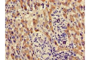 Immunohistochemistry of paraffin-embedded human liver cancer using ABIN7142142 at dilution of 1:100 (ACMSD 抗体  (AA 33-129))
