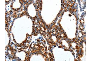 The image on the left is immunohistochemistry of paraffin-embedded Human thyroid cancer tissue using ABIN7191529(MTNR1A Antibody) at dilution 1/40, on the right is treated with synthetic peptide. (Melatonin Receptor 1A 抗体)