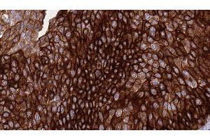 ABIN6276414 at 1/100 staining Human urothelial cancer tissue by IHC-P. (ERBB3 抗体  (C-Term))