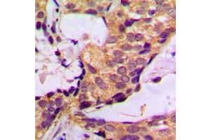 Immunohistochemical analysis of Histone Deacetylase 6 staining in human breast cancer formalin fixed paraffin embedded tissue section.