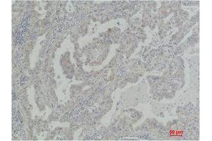 Immunohistochemistry (IHC) analysis of paraffin-embedded Human Lung Carcinoma using Akt2 Polyclonal Antibody. (AKT2 抗体)